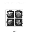 RETROGRADE DELIVERY OF SDF-1 FOR TREATMENT OF MYOCARDIAL INFARCTION diagram and image