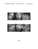 RETROGRADE DELIVERY OF SDF-1 FOR TREATMENT OF MYOCARDIAL INFARCTION diagram and image