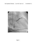 RETROGRADE DELIVERY OF SDF-1 FOR TREATMENT OF MYOCARDIAL INFARCTION diagram and image