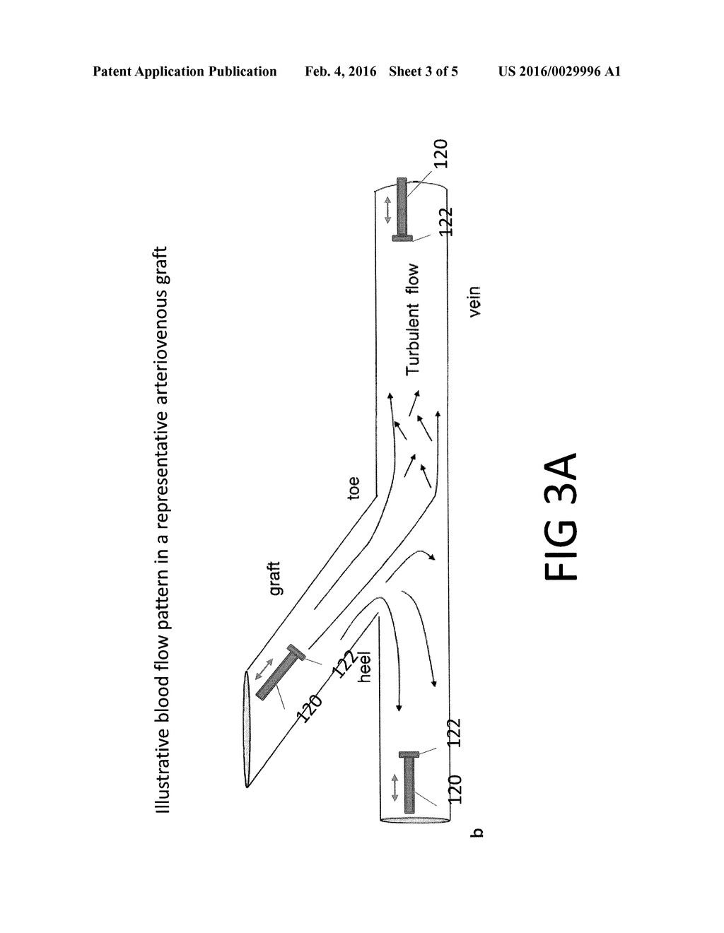 DEVICE AND METHOD FOR USING IVUS DATA TO CHARACTERIZE AND EVALUATE A     VASCULAR GRAFT CONDITION - diagram, schematic, and image 04