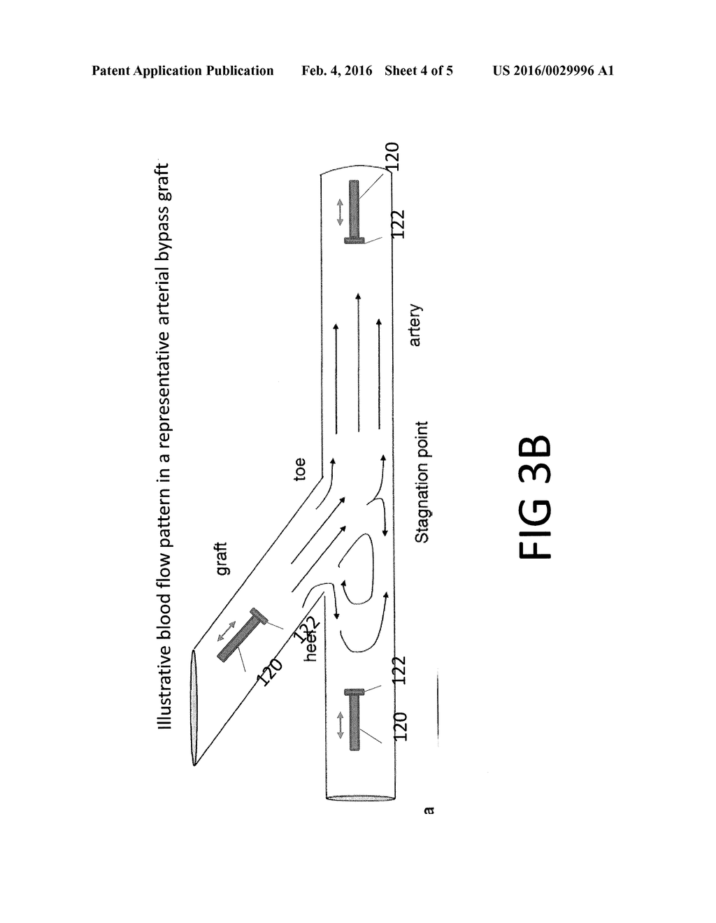 DEVICE AND METHOD FOR USING IVUS DATA TO CHARACTERIZE AND EVALUATE A     VASCULAR GRAFT CONDITION - diagram, schematic, and image 05