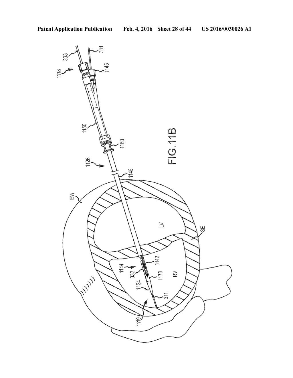 REMOTE PERICARDIAL HEMOSTASIS FOR VENTRICULAR ACCESS AND RECONSTRUCTION OR     OTHER ORGAN THERAPIES - diagram, schematic, and image 29