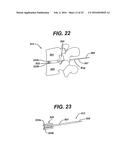 SYSTEMS AND METHODS FOR SPINAL SURGERY diagram and image