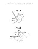 SYSTEMS AND METHODS FOR SPINAL SURGERY diagram and image