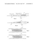 EMBOLISATION SYSTEMS diagram and image