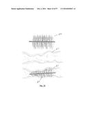 EMBOLISATION SYSTEMS diagram and image