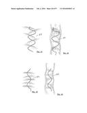 EMBOLISATION SYSTEMS diagram and image