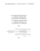 EMBOLISATION SYSTEMS diagram and image