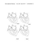 EMBOLISATION SYSTEMS diagram and image