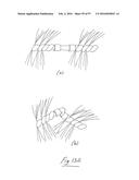 EMBOLISATION SYSTEMS diagram and image