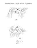 EMBOLISATION SYSTEMS diagram and image