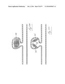 EMBOLISATION SYSTEMS diagram and image