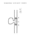 EMBOLISATION SYSTEMS diagram and image