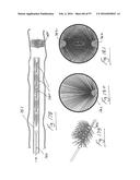 EMBOLISATION SYSTEMS diagram and image