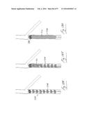 EMBOLISATION SYSTEMS diagram and image