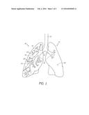 BRONCHOSCOPIC REPAIR OF AIR LEAKS IN A LUNG diagram and image