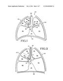 REMOVABLE LUNG REDUCTION DEVICES, SYSTEMS, AND METHODS diagram and image