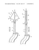 REMOVABLE LUNG REDUCTION DEVICES, SYSTEMS, AND METHODS diagram and image