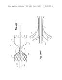 ENDOVASCULAR OCCLUSION DEVICE WITH HEMODYNAMICALLY ENHANCED SEALING AND     ANCHORING diagram and image