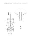 ENDOVASCULAR OCCLUSION DEVICE WITH HEMODYNAMICALLY ENHANCED SEALING AND     ANCHORING diagram and image