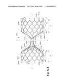 ENDOVASCULAR OCCLUSION DEVICE WITH HEMODYNAMICALLY ENHANCED SEALING AND     ANCHORING diagram and image