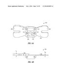 INSTRUMENTS AND METHODS IN PERFORMING KINEMATICALLY-ALIGNED TOTAL KNEE     ARTHROPLASTY diagram and image