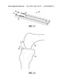 INSTRUMENTS AND METHODS IN PERFORMING KINEMATICALLY-ALIGNED TOTAL KNEE     ARTHROPLASTY diagram and image