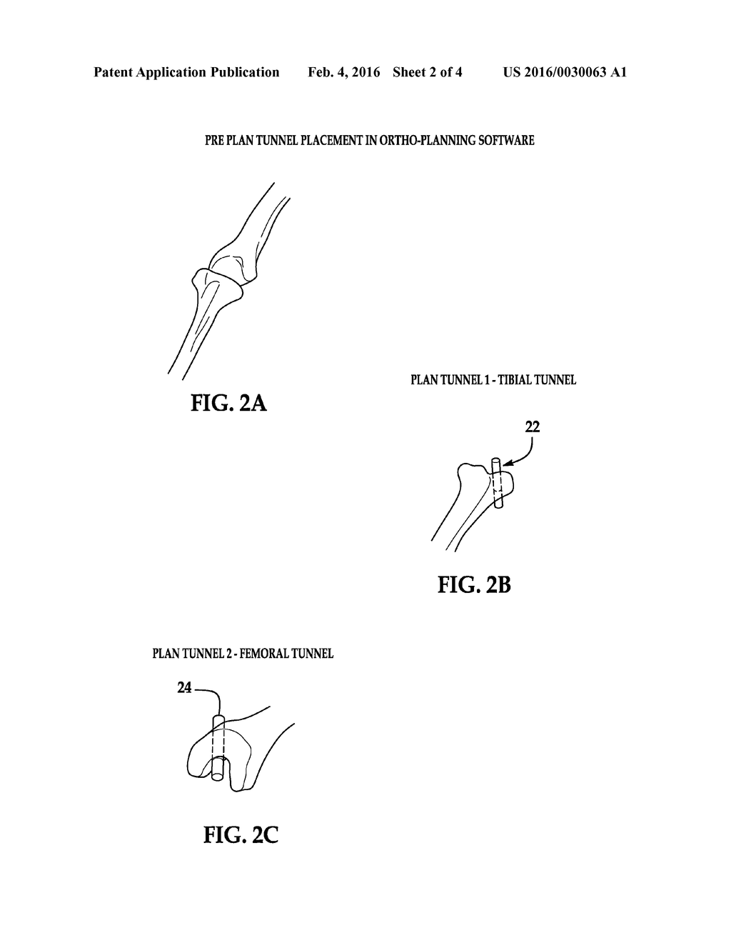 SYSTEMS AND METHODS FOR PRE-OPERATIVE PLANNING AND PRECISE BONE TUNNEL     PLACEMENT FOR LIGAMENT RECONSTRUCTION - diagram, schematic, and image 03