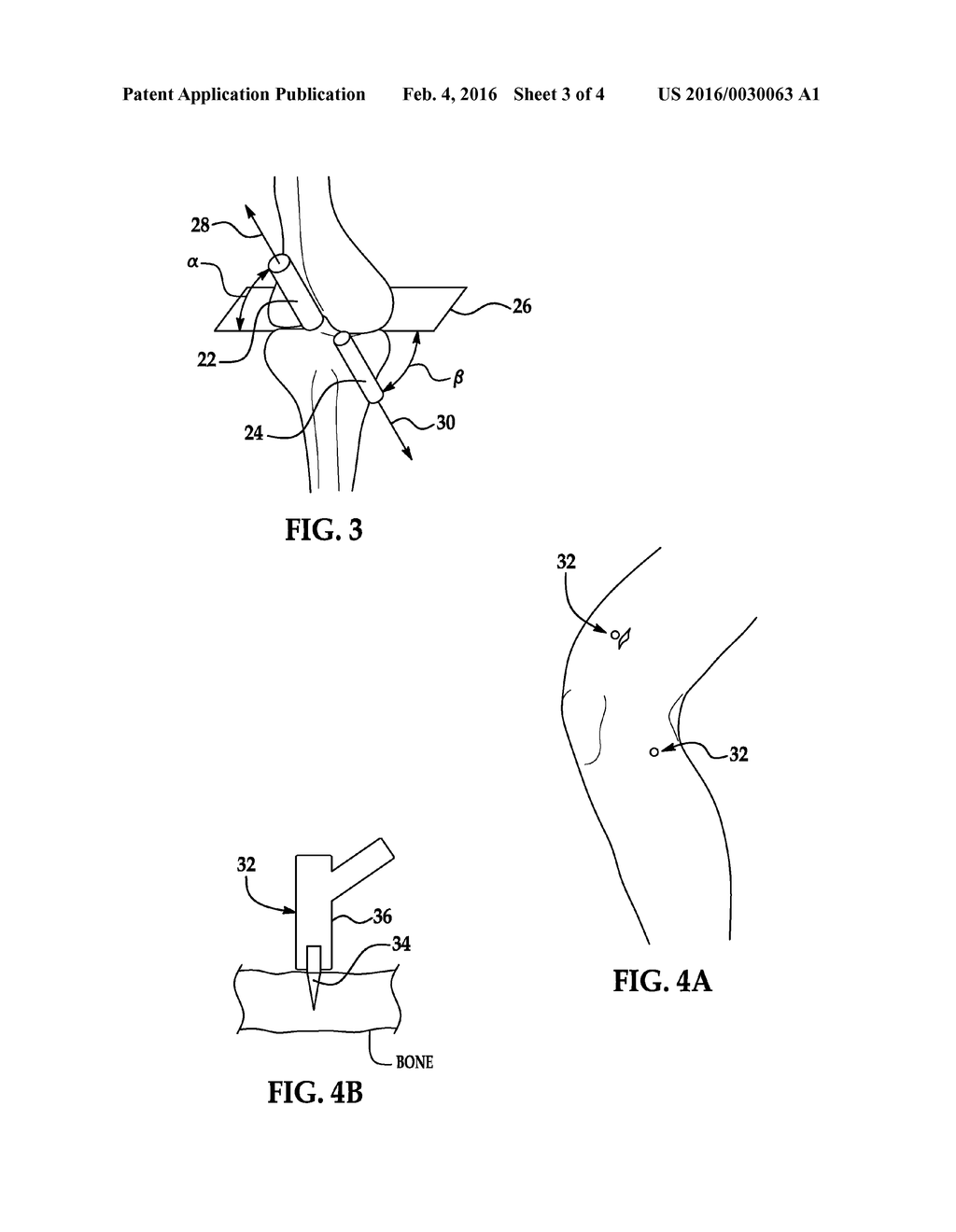 SYSTEMS AND METHODS FOR PRE-OPERATIVE PLANNING AND PRECISE BONE TUNNEL     PLACEMENT FOR LIGAMENT RECONSTRUCTION - diagram, schematic, and image 04