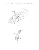 INTRAMEDULLARY NAIL FIXATION GUIDES, DEVICES AND METHODS OF USE diagram and image