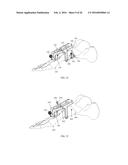 INTRAMEDULLARY NAIL FIXATION GUIDES, DEVICES AND METHODS OF USE diagram and image