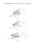 INTRAMEDULLARY NAIL FIXATION GUIDES, DEVICES AND METHODS OF USE diagram and image