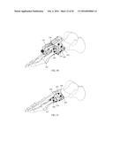 INTRAMEDULLARY NAIL FIXATION GUIDES, DEVICES AND METHODS OF USE diagram and image