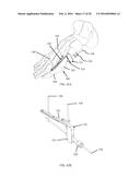 INTRAMEDULLARY NAIL FIXATION GUIDES, DEVICES AND METHODS OF USE diagram and image