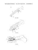 INTRAMEDULLARY NAIL FIXATION GUIDES, DEVICES AND METHODS OF USE diagram and image