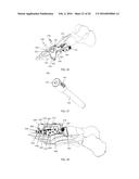 INTRAMEDULLARY NAIL FIXATION GUIDES, DEVICES AND METHODS OF USE diagram and image