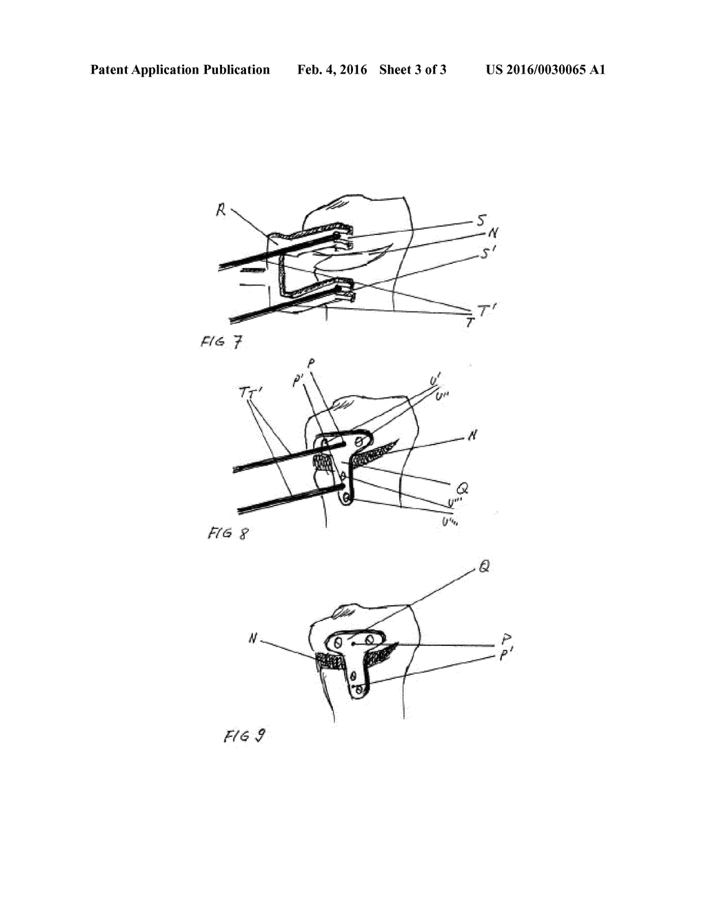 Surgical Device for Proper Orientation during Osteotomy - diagram, schematic, and image 04