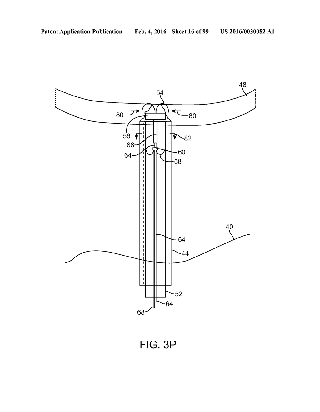 SYSTEM AND METHOD FOR TRANSAPICAL ACCESS AND CLOSURE - diagram, schematic, and image 17