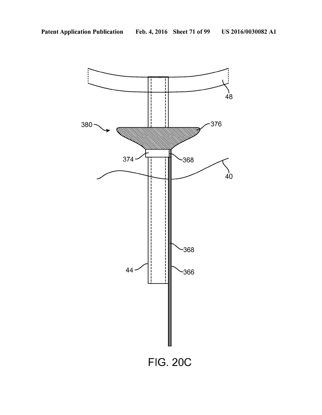 SYSTEM AND METHOD FOR TRANSAPICAL ACCESS AND CLOSURE - diagram, schematic, and image 72