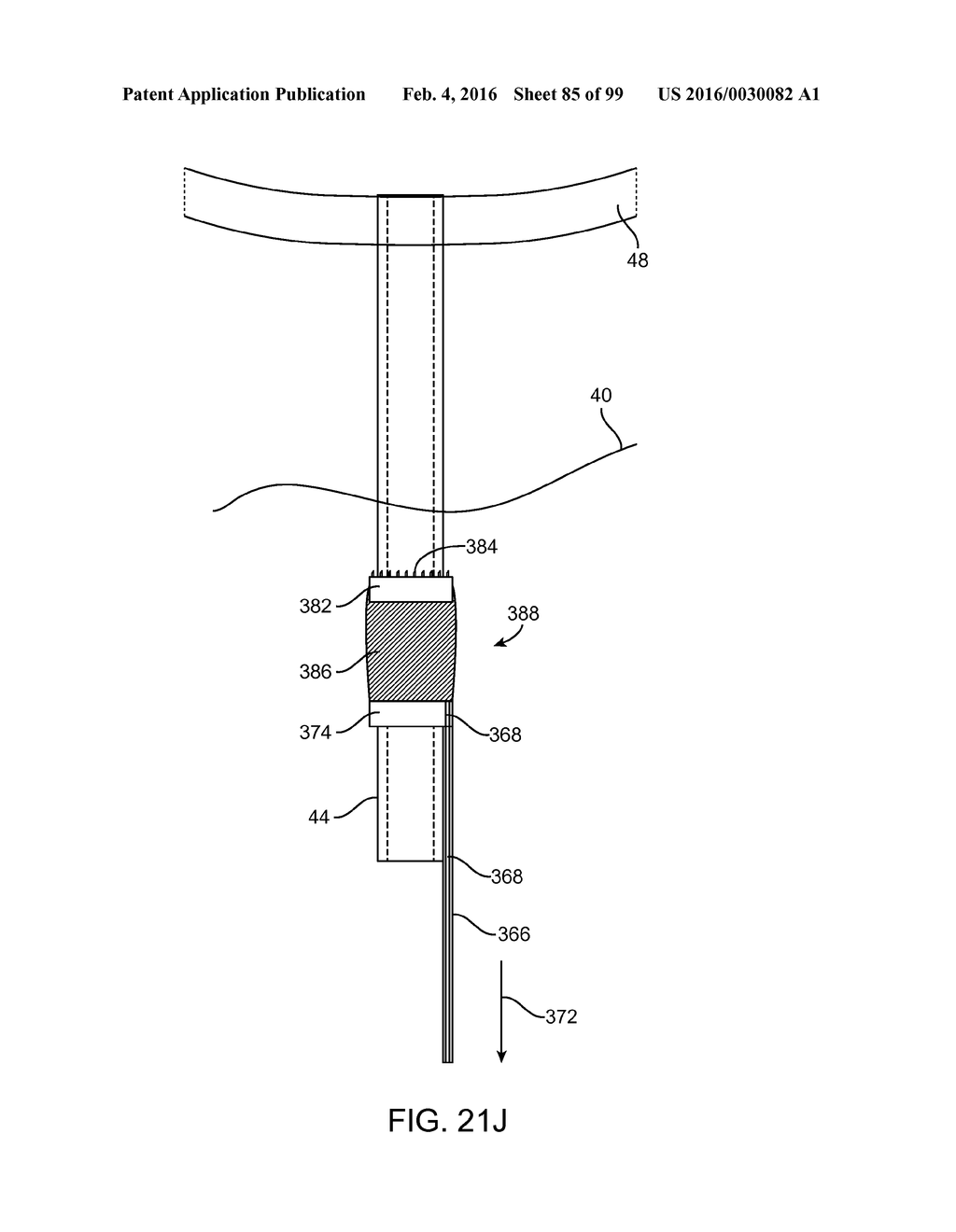 SYSTEM AND METHOD FOR TRANSAPICAL ACCESS AND CLOSURE - diagram, schematic, and image 86