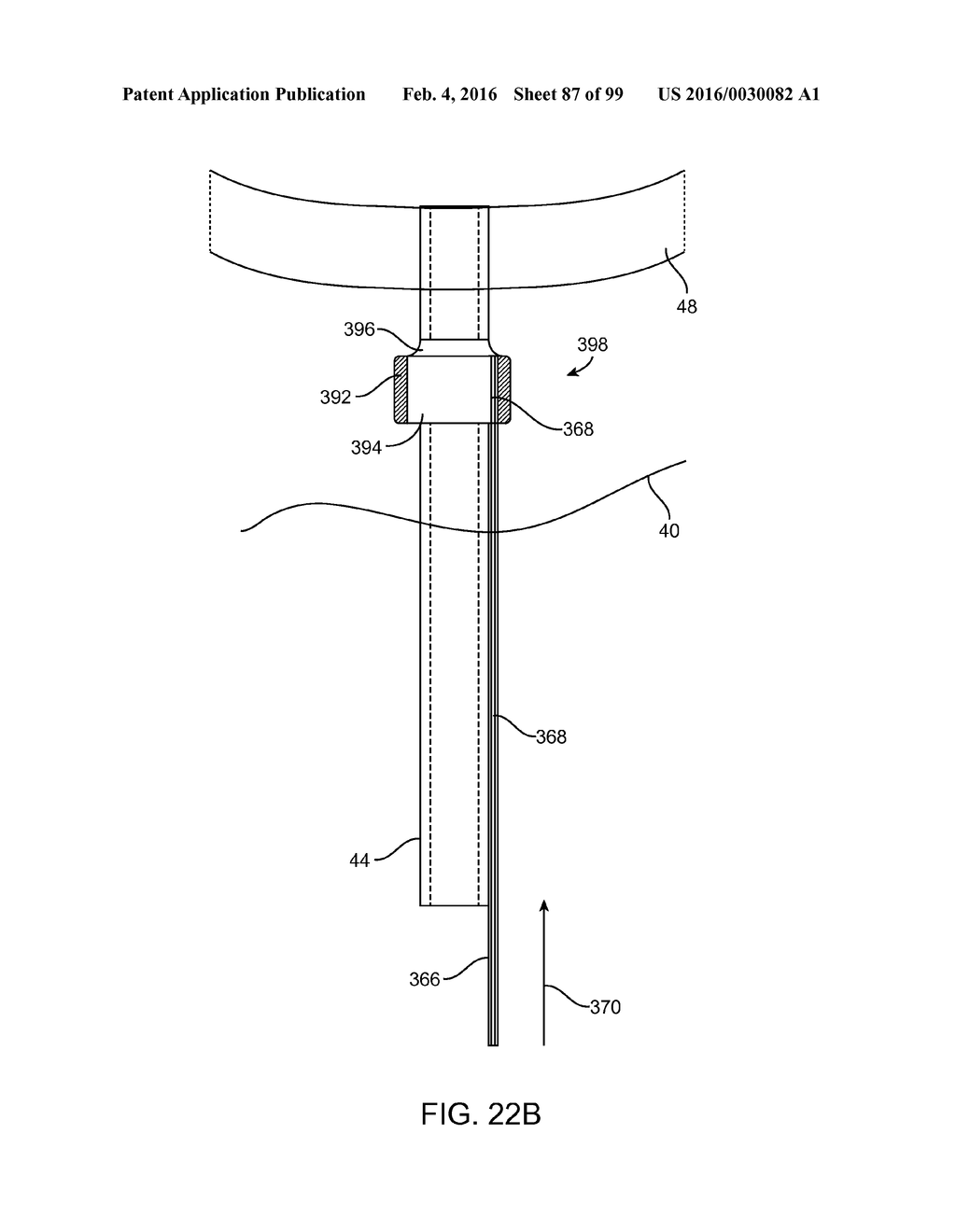 SYSTEM AND METHOD FOR TRANSAPICAL ACCESS AND CLOSURE - diagram, schematic, and image 88