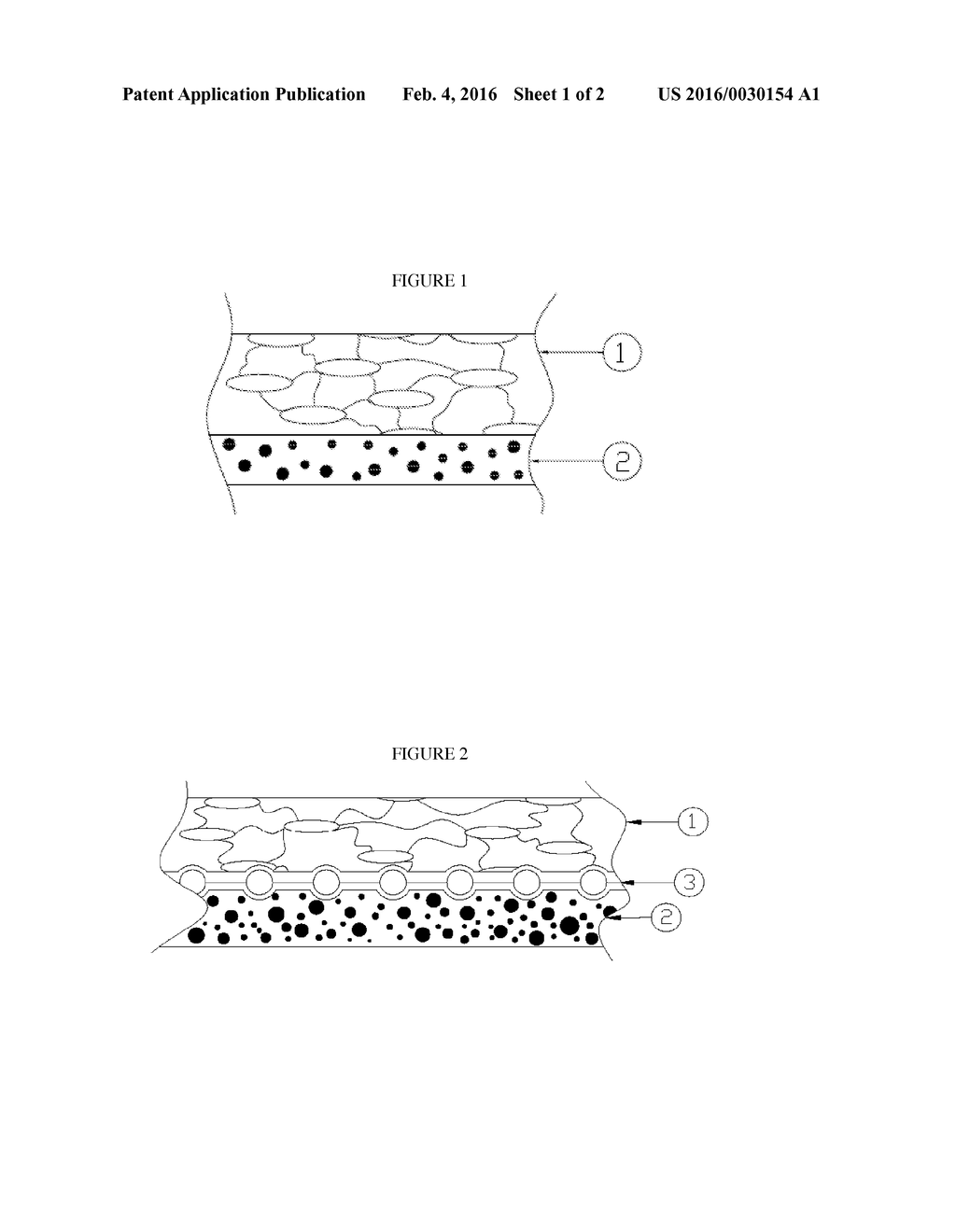 PROSTHETIC DEVICE INCLUDING ELECTROSTATICALLY SPUN FIBROUS LAYER AND     METHOD FOR MAKING THE SAME - diagram, schematic, and image 02