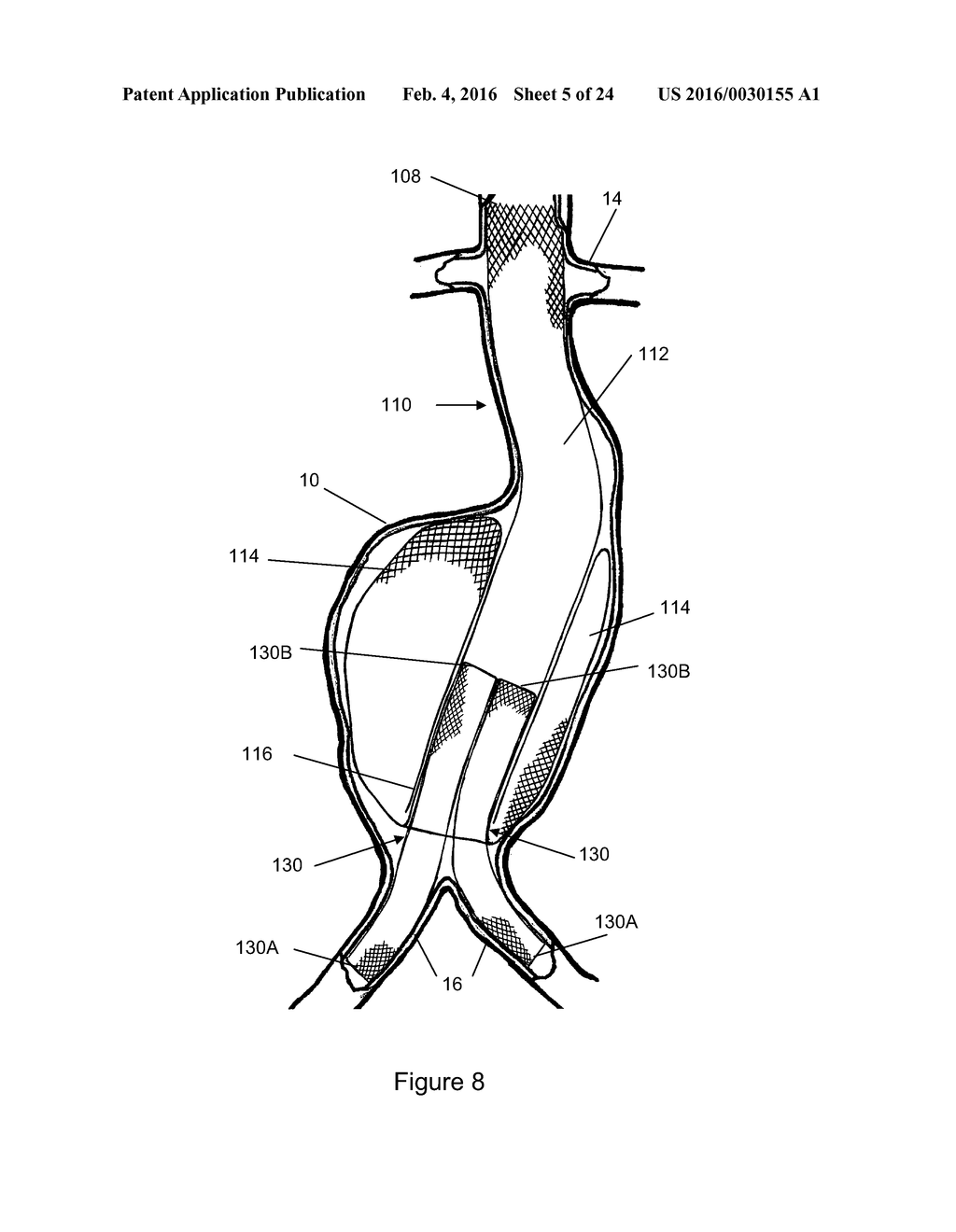 Aneurysm Graft With Stabilization - diagram, schematic, and image 06