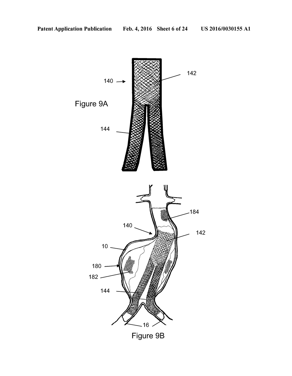 Aneurysm Graft With Stabilization - diagram, schematic, and image 07