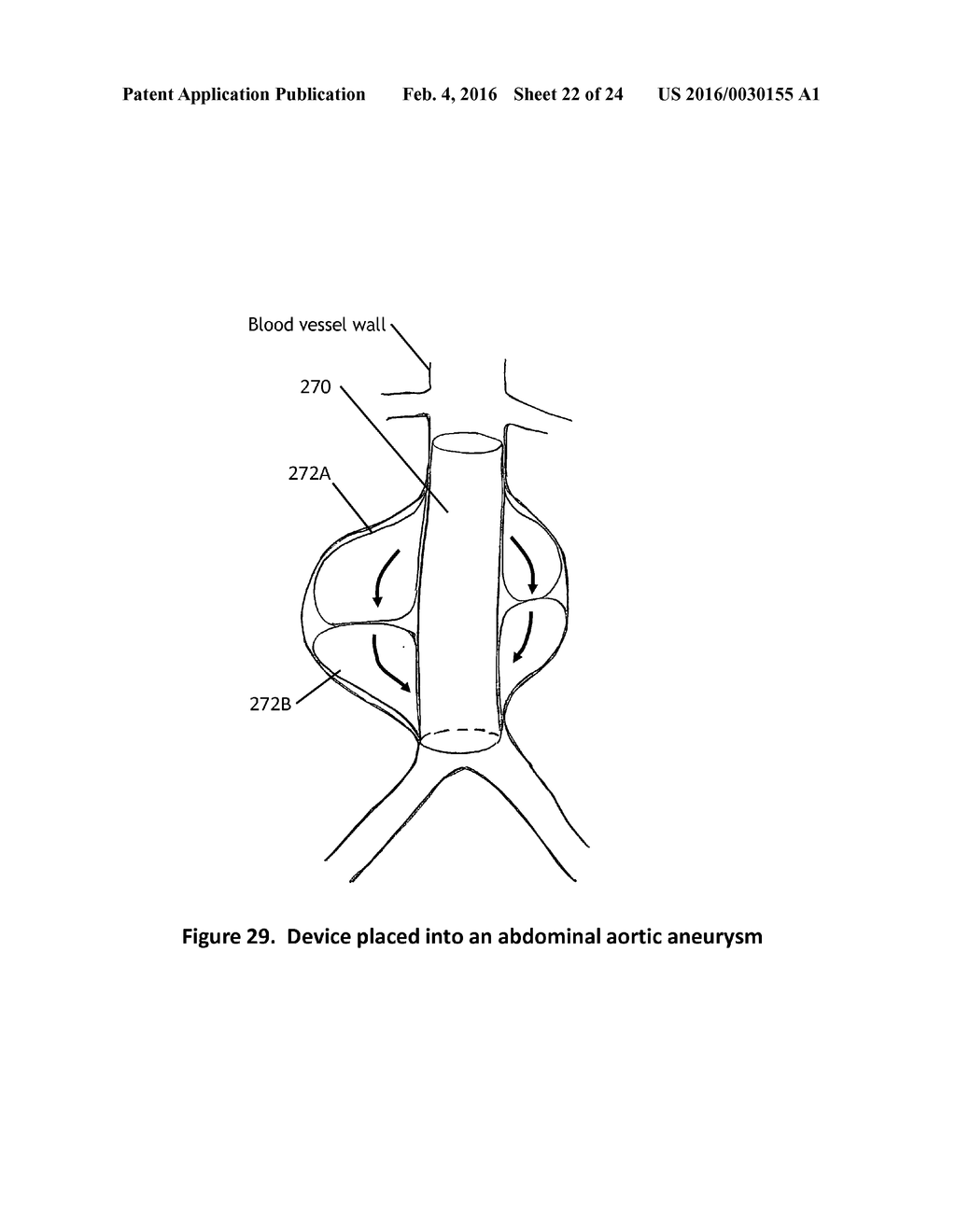 Aneurysm Graft With Stabilization - diagram, schematic, and image 23