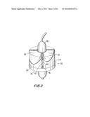 PROSTHETIC HEART VALVE AND METHOD diagram and image