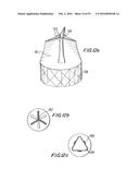 PROSTHETIC HEART VALVE AND METHOD diagram and image