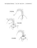 PROSTHETIC HEART VALVE AND METHOD diagram and image