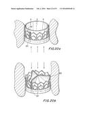 PROSTHETIC HEART VALVE AND METHOD diagram and image