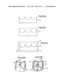 PROSTHETIC HEART VALVE AND METHOD diagram and image